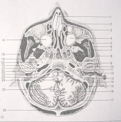 External auditory canal 14. Mastoid air cells 15. Sigmoid sinus 16. Cerebellar hemisphere 17. Occipital sinus 18. Sphenoid 19.