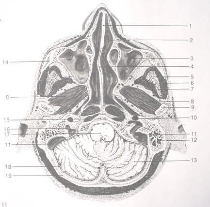 Sigmoid sinus with crossing to internal jugular vein 12. Mastoid air cells 13. Cerebellum 14. Zygomatic bone 15.