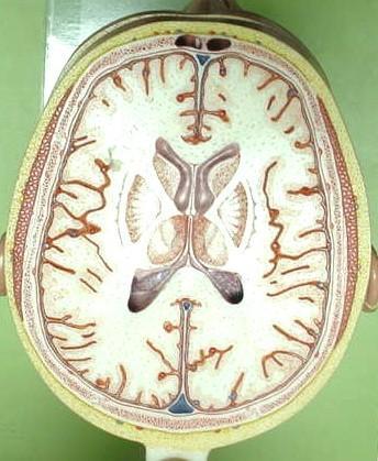 TRANSVERSE SECTION PLANE 4 1. Frontal sinus 2. Superior sagittal sinus 3. Falx cerebri 4. Dura mater 5. Frontal lobes of the cerebrum 6.