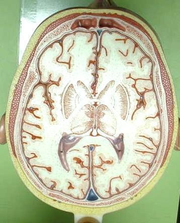TRANSVERSE SECTION PLANE 5 1. Frontal sinus 2. Superior sagittal sinus 3. Falx cerebri 4. Dura mater 5. Frontal lobes of the cerebrum 6.