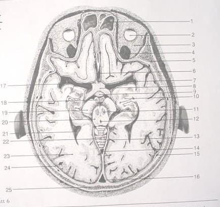 Tentorium cerebelli 14. Straight sinus 15. Branch of the middle meningeal artery 16. Superior sagittal sinus 17. Optic nerve 18.