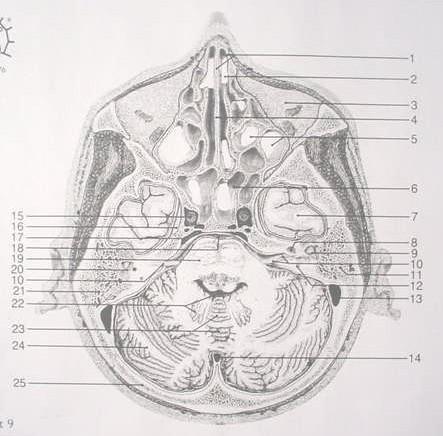 Posterior semicircular canal 13. Sigmoid sinus 14. Occipital sinus 15. Internal carotid artery 16. Maxillary nerve 17. Venous plexus 18.