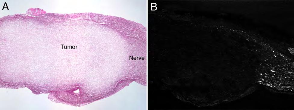 Fig. 3. PDT applied to advanced PNST creates a barrier to nerve regeneration. A) PDT induced extensive PNST cell death. One month after PDT the tumor tissue became a fibrotic scar.
