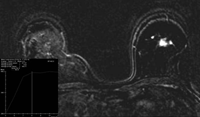 Axial T1-weighted contrastenhanced MRI (c) shows another lesion with a linear shape. The histopathological diagnosis of the primary mass on total mastectomy was tubulolobular carcinoma.