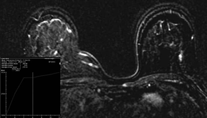 When considering its effects on the surgical plan, the sensitivity of the breast MRI was 85%, the specificity was 98%, and the positive predictive value in terms of detecting additional positive