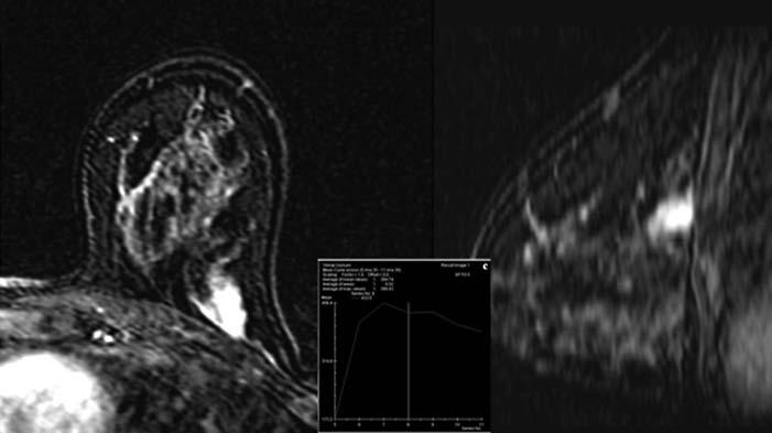 a b Figure 2. a, b. MRI of a 48-year-old female patient. Axial and sagittal T1-weighted contrastenhanced MRI (a) shows an irregularly shaped mass with a type 3 dynamic enhancement pattern.