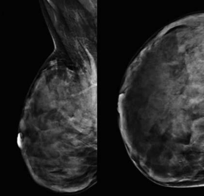 Axial and sagittal T1-weighted contrast-enhanced MRI (b) shows another lesion with a similar morphology and enhancement pattern, with a suspicious additional focus on the same breast.