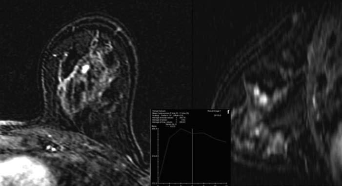 Breast MRI examinations performed prior to the surgery reduce the rate of positive surgical margin because this imaging technique demonstrates the true margins of the tumor.