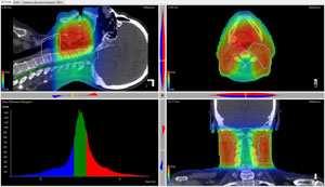 3DVH Option The most advanced 3D patient dose and DVH tools available Uses existing ArcCHECK measurements Supports VMAT and