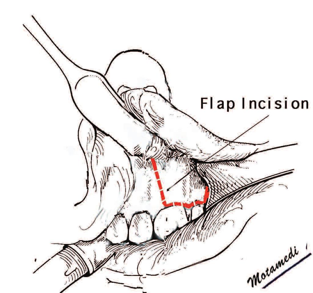 Surgical Technique A full-thickness trapezoid mucoperiosteal flap was reflected buccally from the line angle of the first molar, extending posteriorly to the second molar, and then over the