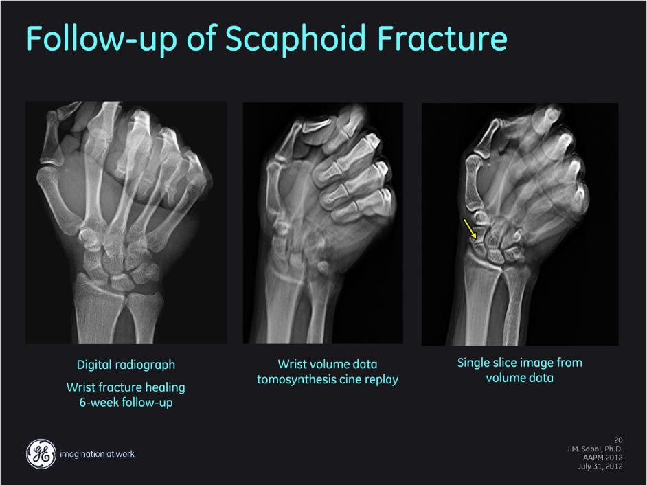 Patient imaged for routine follow-up of treatment for a fracture of the scaphoid. Conventional radiograph (left) appears to shown good evidence of healing (increased bone density at fracture site).