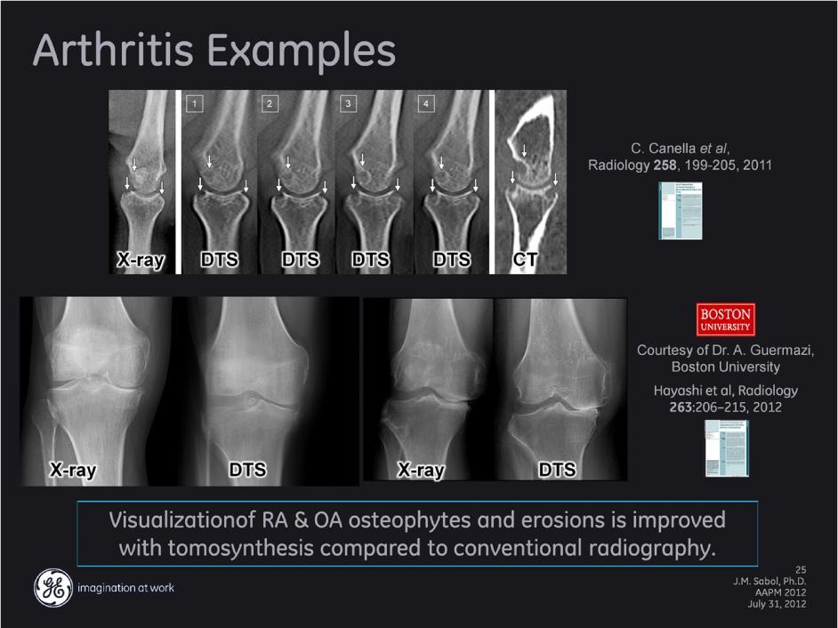 Upper: Examples of improved visualization and characterization of bone erosions in a patient with rheumatoid arthritis.
