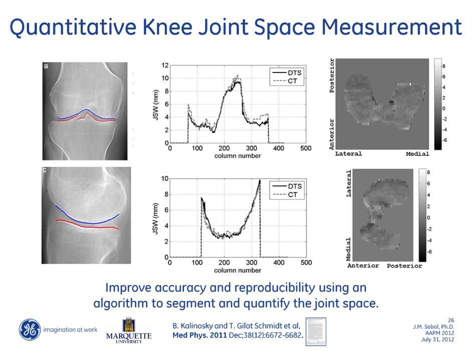 With tomosynthesis imaging, it is possible to extract quantitative information about the joint space.