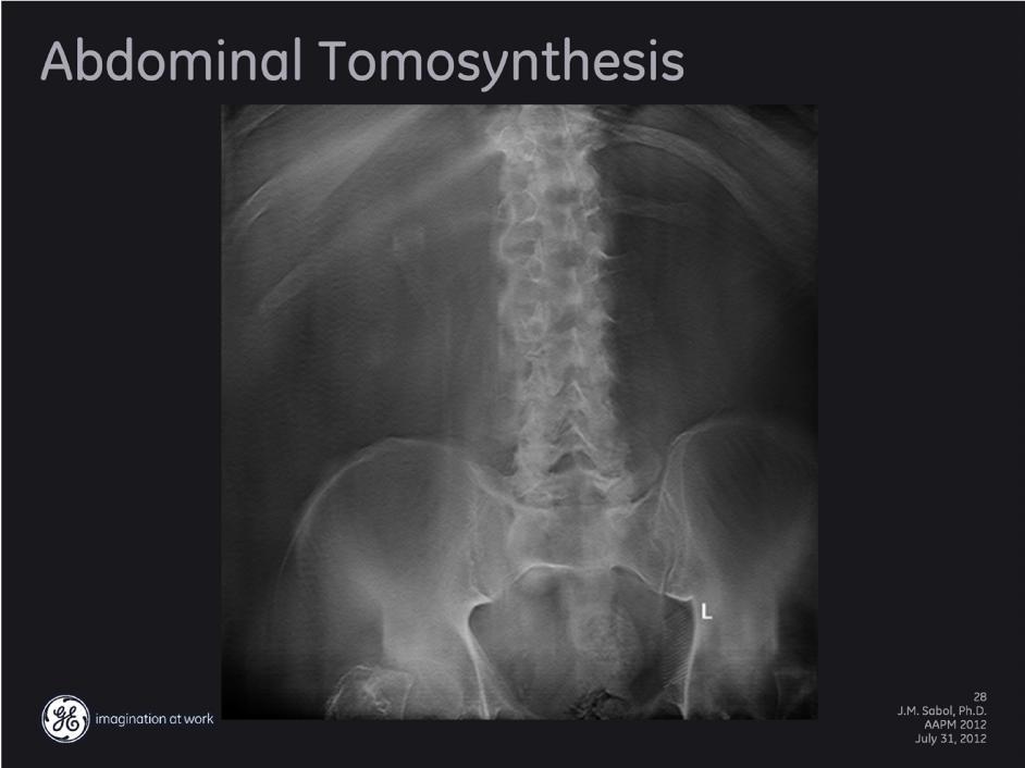 Globally, IVP procedures with traditional x-ray is still a common procedure. Tomosynthesis replaces the need for linear tomography which is prone to fulcrum errors and increased dose.