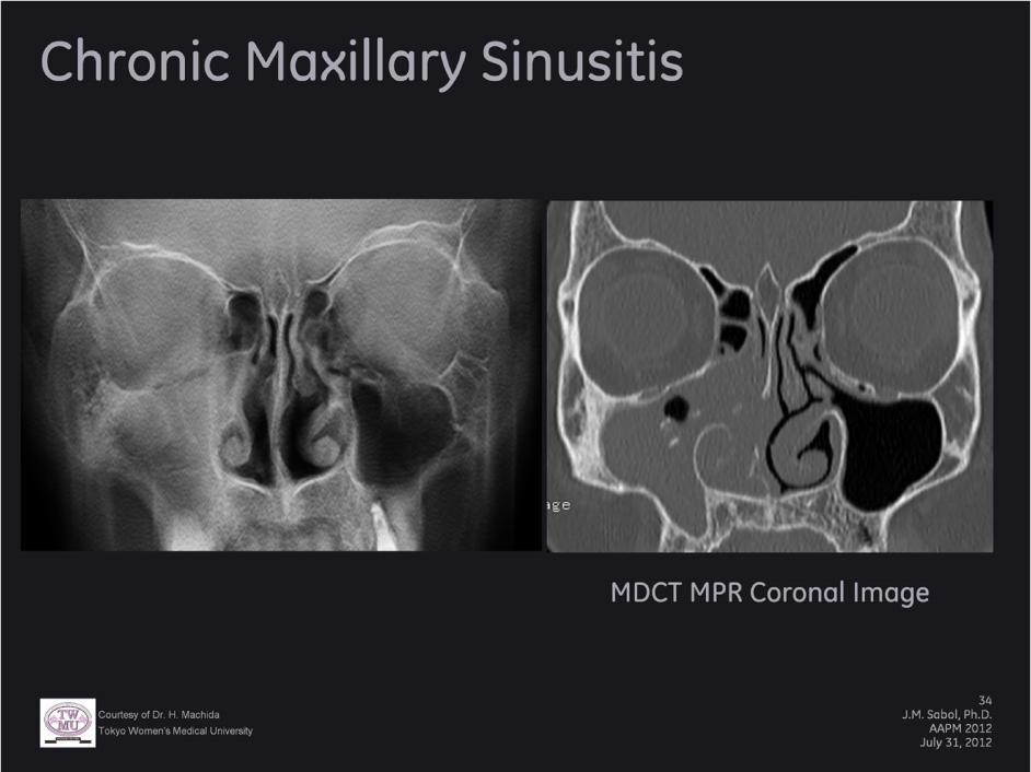Chronic maxillary sinusitis with obstruction of the natural ostia clearly visible on the tomosynthesis images (left).