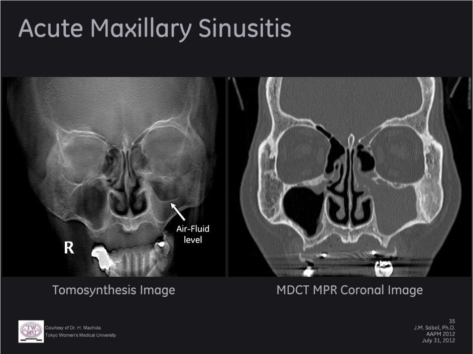 Acute maxillary sinusitis as demonstrated on sinus tomosynthesis and MDCT MPR coronal images.