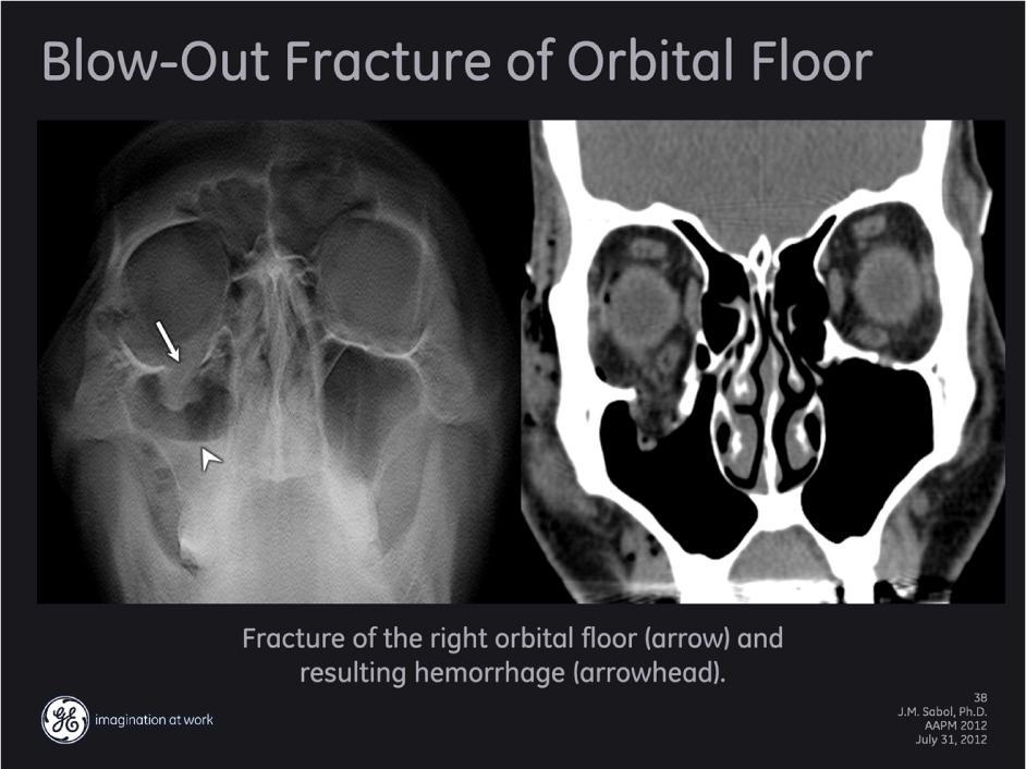 Example of a blow-out fracture on both tomosynthesis and CT MPR coronal images. The tomosynthesis image clearly delineates the fracture of the right orbital floor.