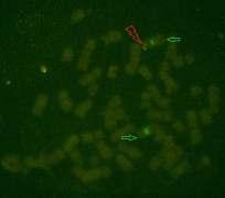 Diagnosis Chromosome analysis showed a 46,XX karyotype Translocation of SRY gene (testisdetermining factor) from chromosome Y to chromosome X was identified by fluorescence in situ hybridization