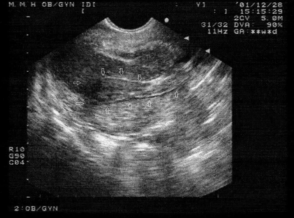 Endometrial Cancer - Ultrasound Features Photo courtesy of Dr. M. Azodi, Yale Gynecologic Oncology Patient Presentation (con t.