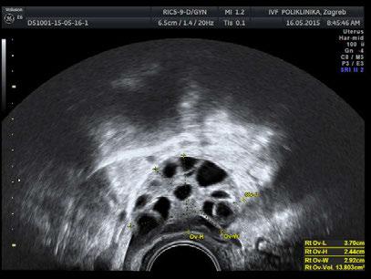 Ovarian volume (OV) o Good surrogate marker o Less sensitivity compared with FNPO o