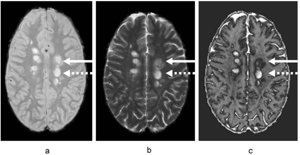 734 Multiple Sclerosis Journal 19(6) Figure 2. (a) PDw image in an MS patient with the corresponding (b) T2w image and (c) ADIMA image.