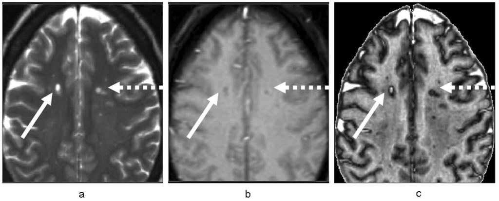 736 Multiple Sclerosis Journal 19(6) Figure 3. (a) T2w image in an MS patient with the patient s corresponding (b) T1w image and (c) ADIMA image.