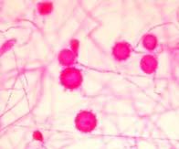 Endemic Mycoses Thermally dimorphic fungi Infectious conidia or arthrospores inhaled Primary pulmonary infection asymptomatic in competent hosts May progress to dissemination in immunocompromised
