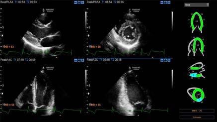 Advanced QuickScan TM IMT (Intima-Media Thickness) measured with Auto IMT+ ROI Positioning