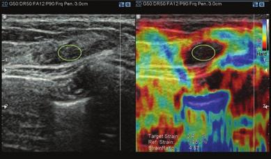 surrounding fatty tissues. Unlike conventional ultrasound elastography, E-Breast requires only one ROI to be selected by the user.