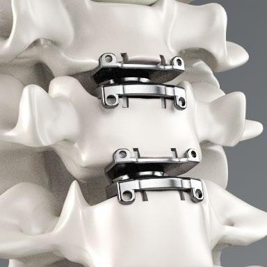 REIMBURSEMENT GUIDE Prestige LP Cervical Disc System The Prestige LP Cervical Disc is indicated in skeletally mature patients for reconstruction of the disc from C3-C7 following discectomy at one or