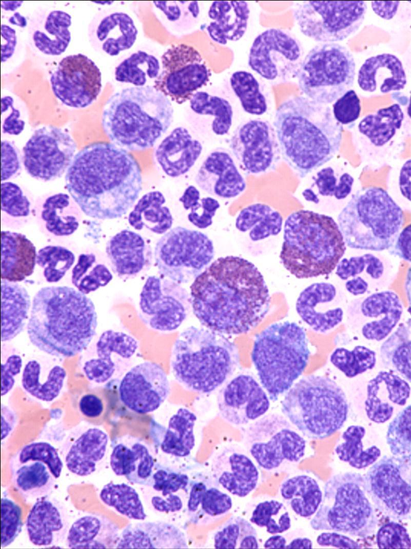 Chronic Myeloid Leukemia (CML) Clonal myeloproliferative disorder of pluripotent stem cells proliferation, apoptosis Cytogenetic hallmark: