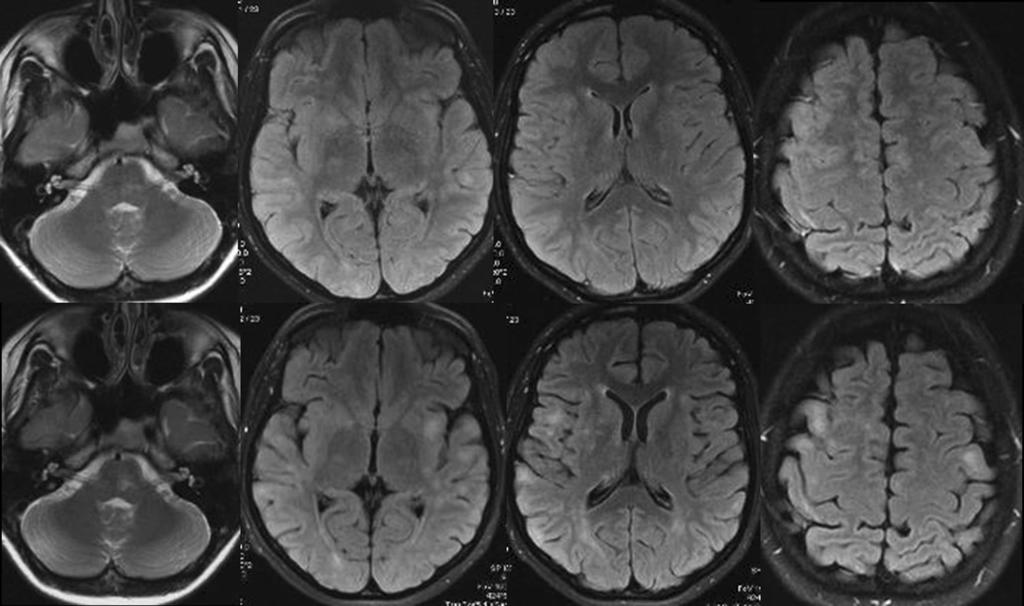 Fig. 3 Axial T2- and T2-FLAIR images, two MRI examinations in case 2.