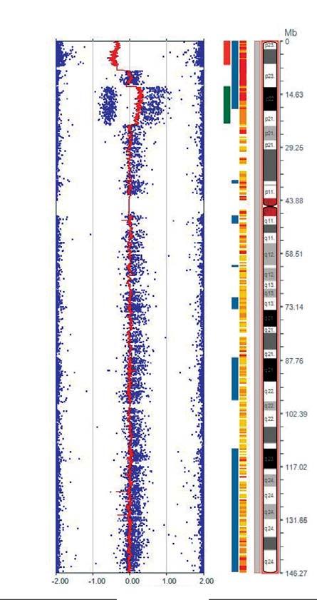 > Detection of a complex genomic changes in patient with ID Deletion B B Allele Freq 0.0 0.25 0.5 0.75 1 AA BB DGV Knowm Reg Found Reg Duplication AAA AAB ABB BBB AA AB BB Normal -2.00-1.00 0.00 1.