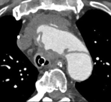Pseudoaneurysm with Aortotracheal Fistula Rare and potentially fatal complication Effacement of fat plane with trachea Tend