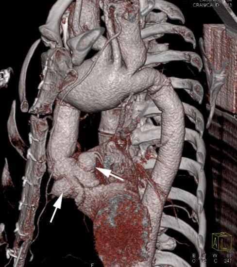 Coronary Ostial Aneurysm Dilatation of coronary artery reimplantation site > 10 mm Perioperative stretch of weakened ostial wall Increased risk in