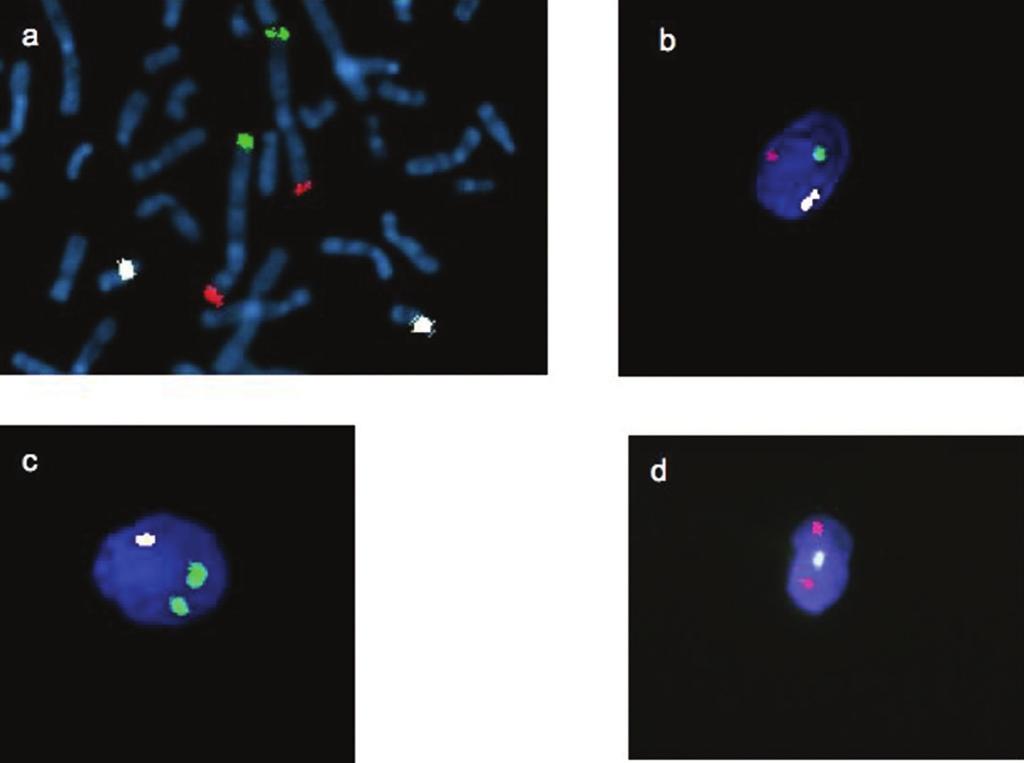 Sperm-FISH analysis in a pericentric chromosome 1 inversion Figure 3.