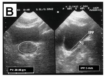 Steele, Kuo and Ockrim et al 6,8,9 used transrectal ultrasound to measure PV and configuration for predicting BPO.The transrectal approach is inconvenient and uncomfortable to patients.