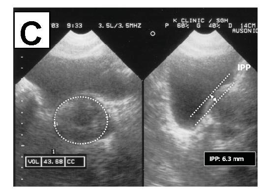 Bedside ultrasound has been routinely used for evaluating the anatomical size (PV) and configuration (IPP) of the prostate gland and assessing postvoid residual urine (PVR) of patients with LUTS