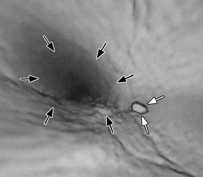 C, In virtual cystoscopy image with same projection as (attenuation coefficient range, 100 1400 H), artifacts (black arrows) fade and polypoid lesion (white arrows) is now visible.