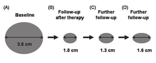 9 larification of disease progression. Target lesion at baseline () has longest diameter of 3.0 cm. On follow-up study after initiation of therapy (), lesion measures 1.