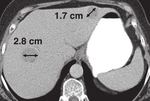 arrows) and multiple liver masses (black arrows) representing metastases.