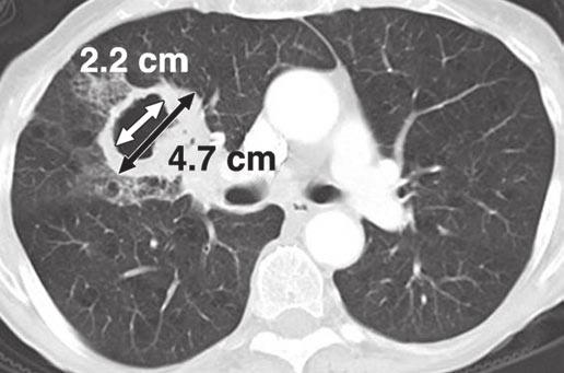 Revised REIST Guideline Fig. 15 avitation of lung lesions. T scan of chest in 78-year-old woman with non small cell lung cancer shows large cavitary lung lesion.