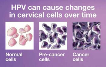 Etiology of Cervical Cancer 4 reliable Stages HPV