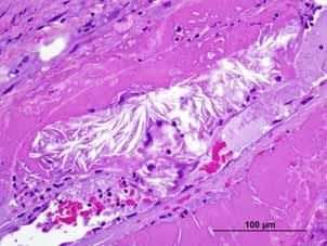 Histologic findings of emboli/vascular changes by coronary band and skeletal