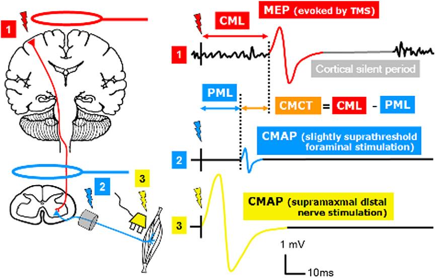 868 S. Groppa et al. / Clinical Neurophysiology 123 (2012) 858 882 dominated by background alpha activity (Rossini et al., 1991).