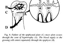 epiphysis growth plate, an apophysis is usually the weakest link in the biomechanical chain in its particular region 0 Also