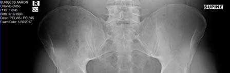 Conservative Treatment McKinney B, Nelson C, Carrion W: Apophyseal avulsion fractures of the hip and pelvis.