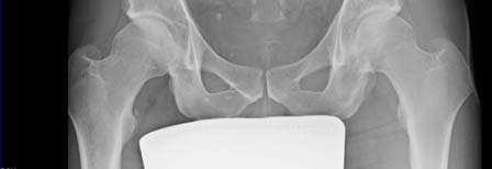 References Thank you 0 McKinney B, Nelson C, Carrion W: Apophyseal avulsion fractures of the hip and pelvis.