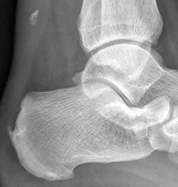 all patients with avulsion fracture of calcaneal tuberosity. Twenty patients with an avulsed calcaneal tuberosity out of a total of 764 cases of calcaneal fractures (2.