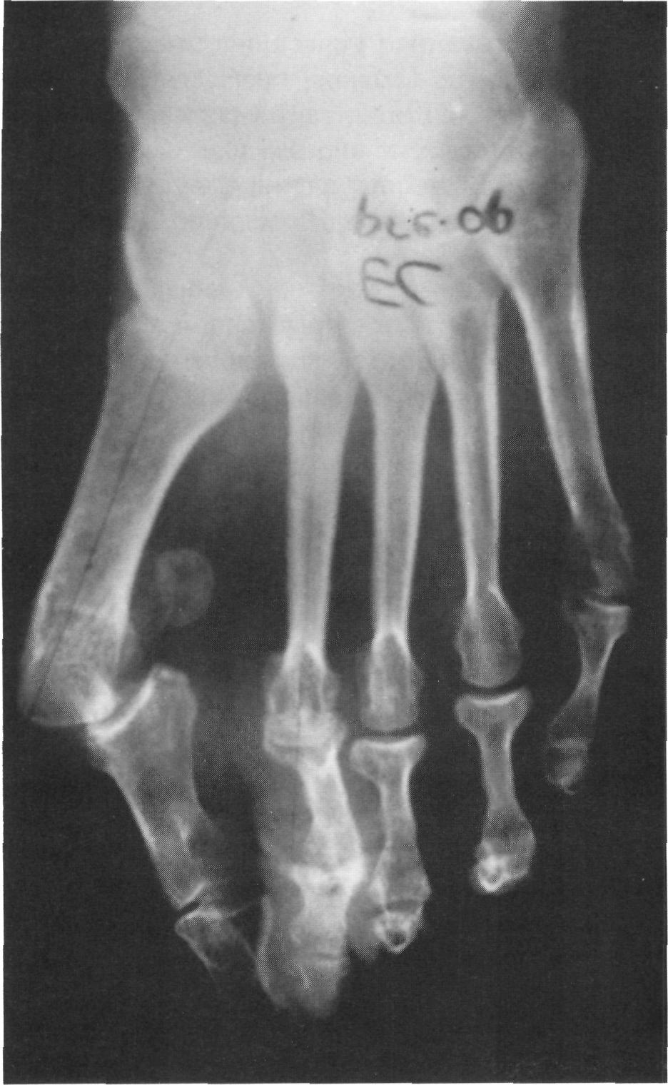 280 HALLUX VALGUS AND FOREFOOT SURGERY taken to assess the articular surface because in severe cases of hallux valgus, the functional articular surface is 20-30 percent of the total joint area.